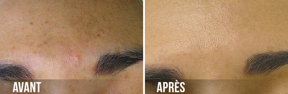 avant/après hydrafacial points noirs