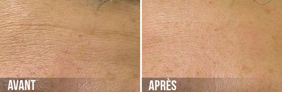 avant/après hydrafacial ridules