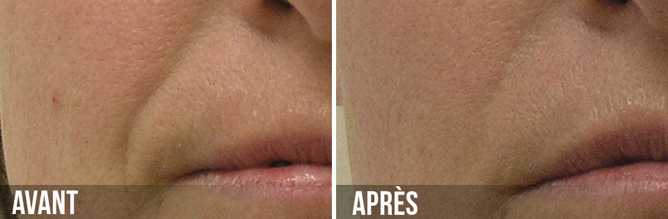 avant/après hydrafacial sillon nasogénien