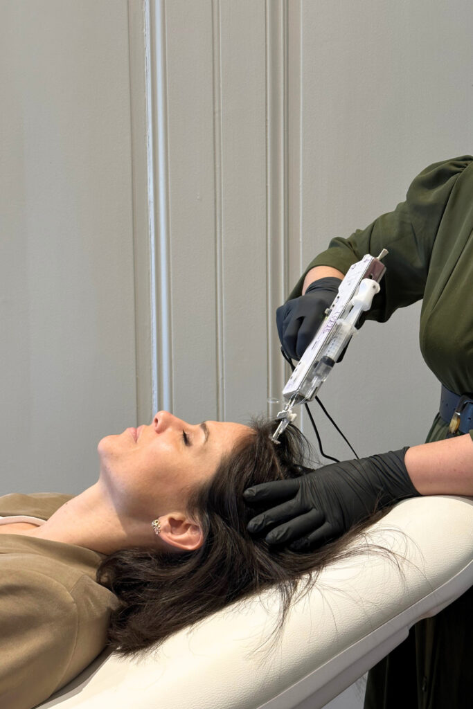 mésotherapie capillaire - traiter la chute de cheveux