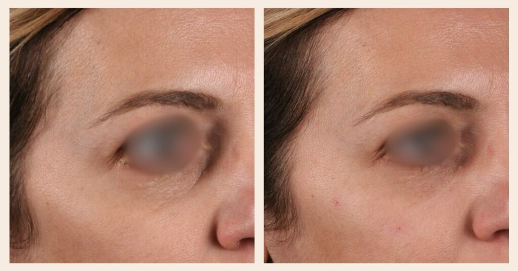 injections acide hyaluronique cernes